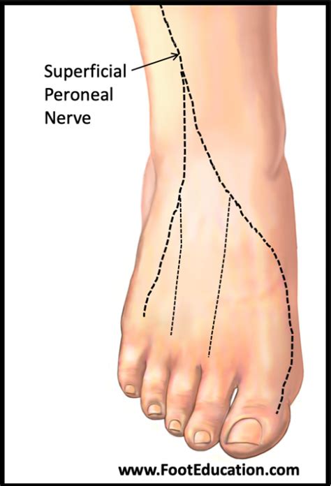 Superficial peroneal nerve entrapment. . Superficial peroneal nerve entrapment